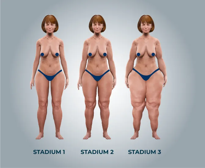 Abbildung der Stadien vom Lipödem
